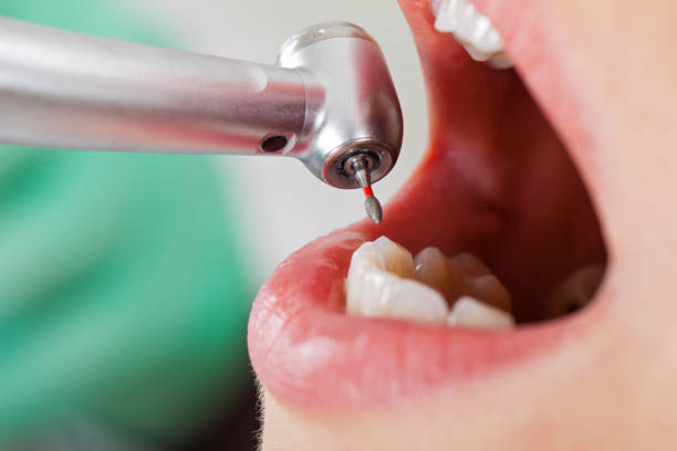 Best Emergency Wisdom Teeth Removal in Ord, NE